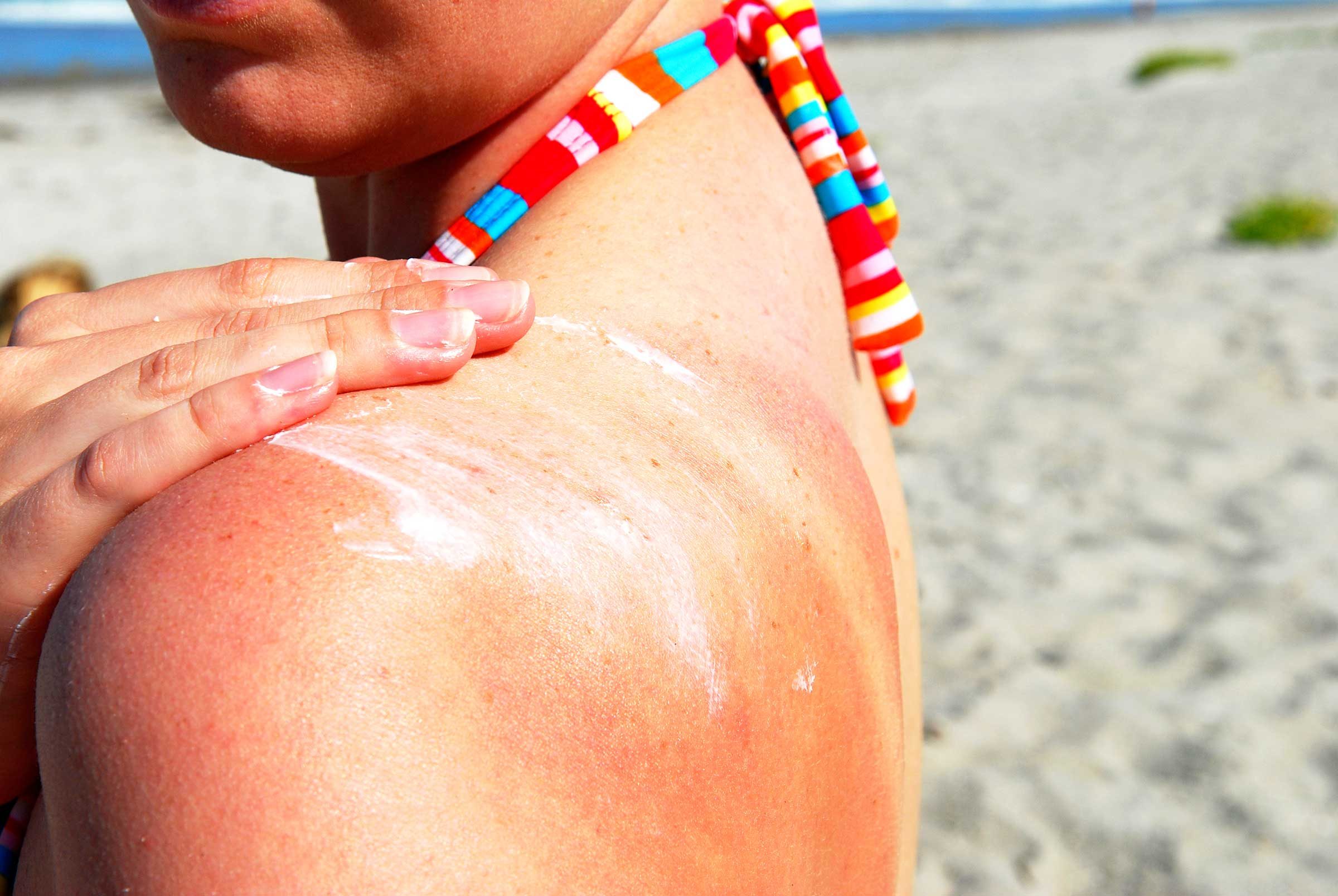 8 Strange Reasons You Got Sunburned (Even If You Wore Sunscreen!)