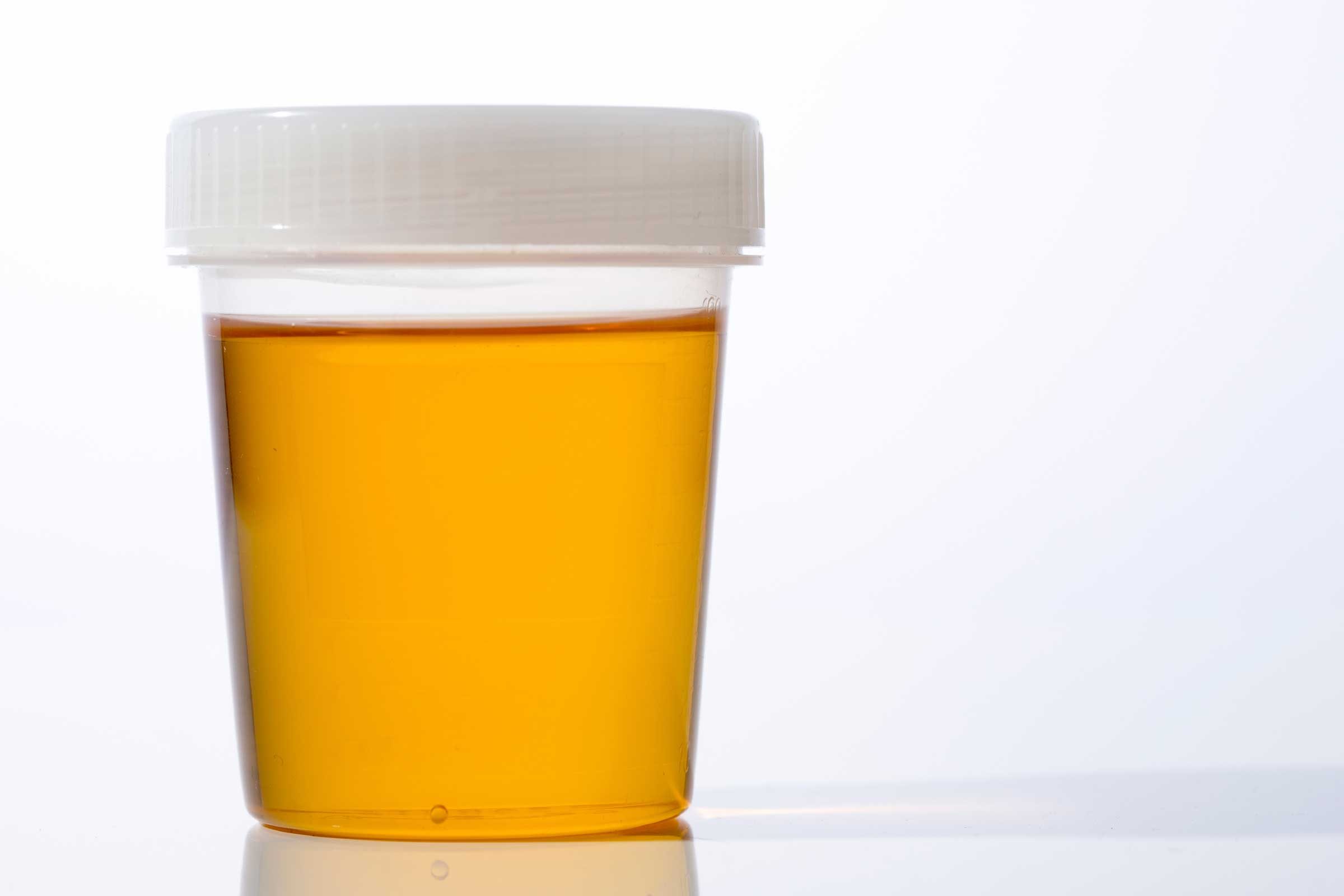 10 Things Your Pee Reveals About Your Health (Besides Dehydration)