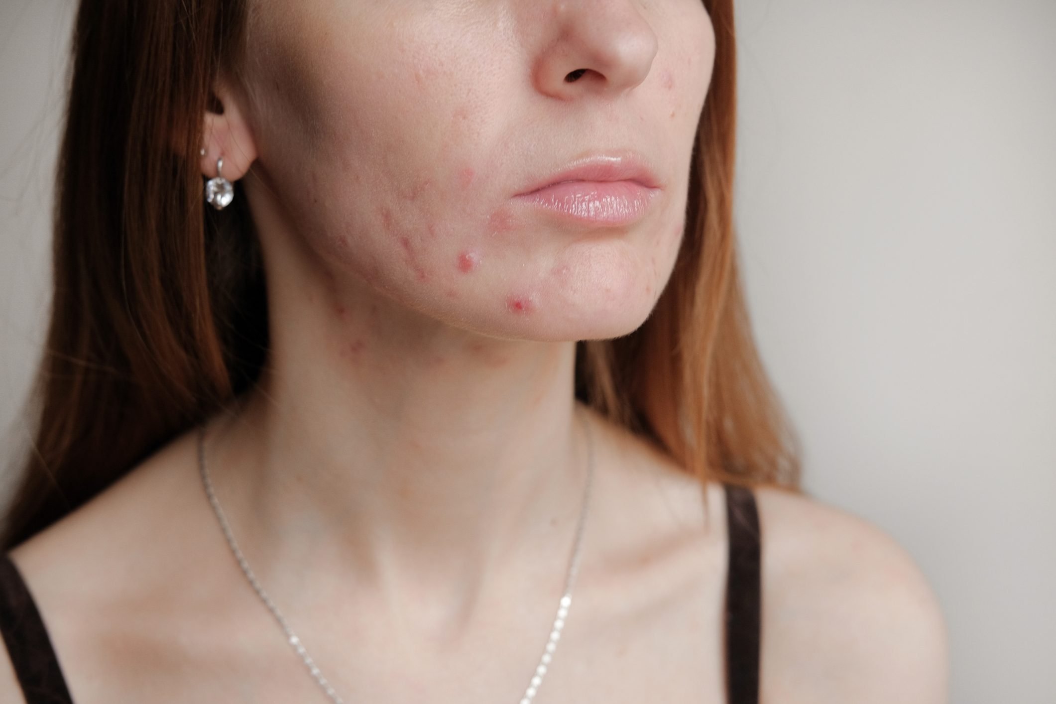 cropped photo of woman with acne on face