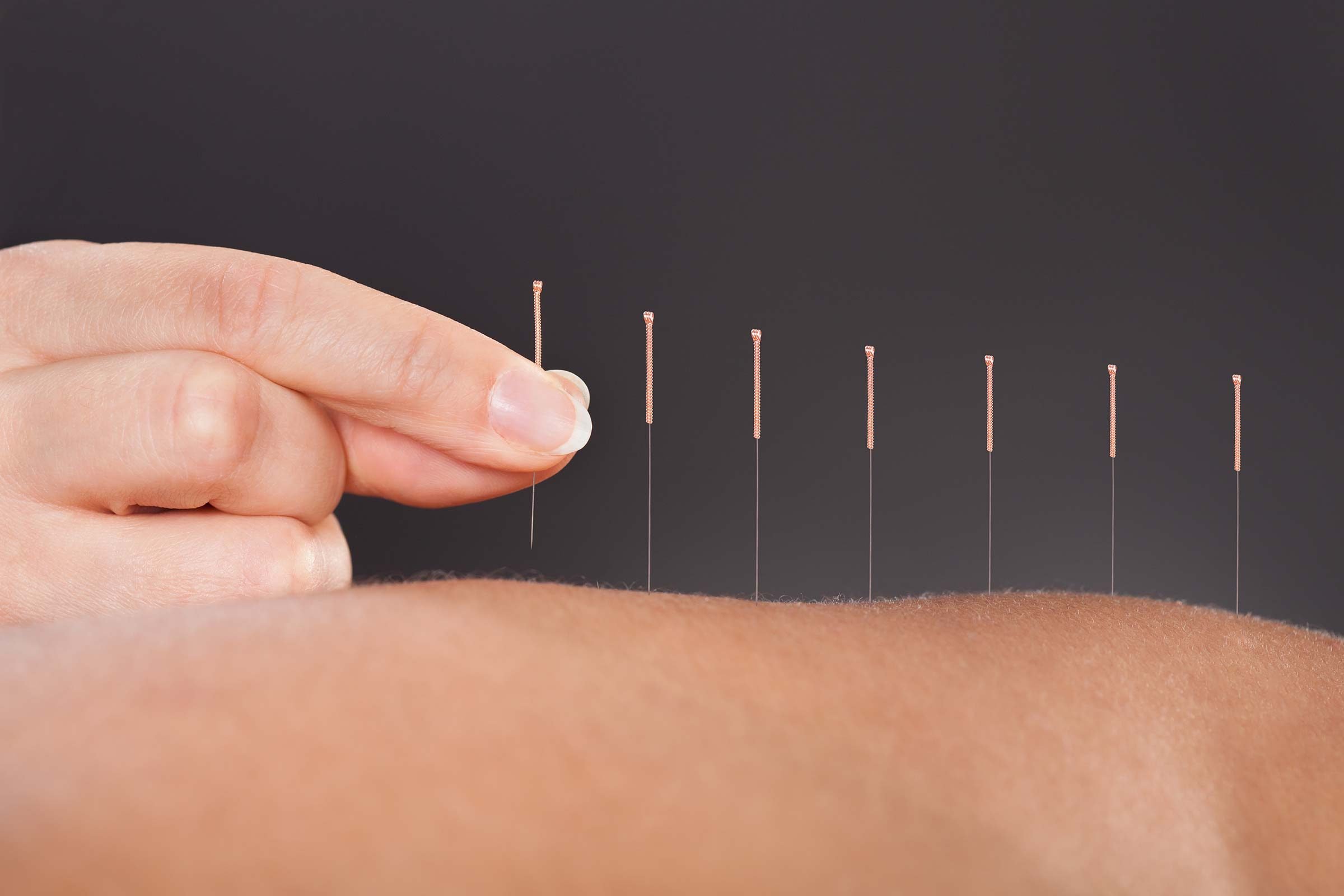 What Is Acupuncture 