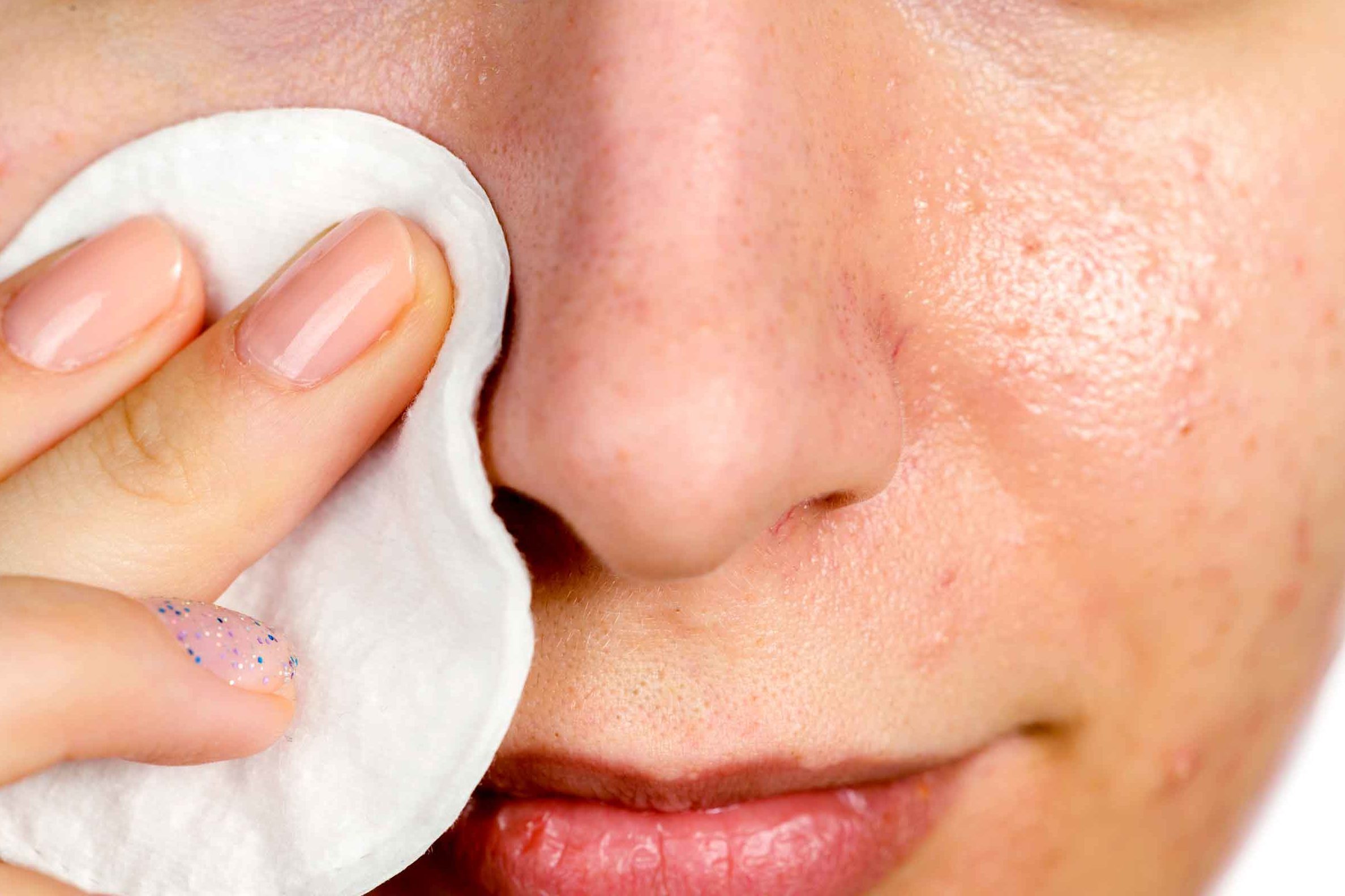 How to Get Rid of Blackheads on Inner Thighs