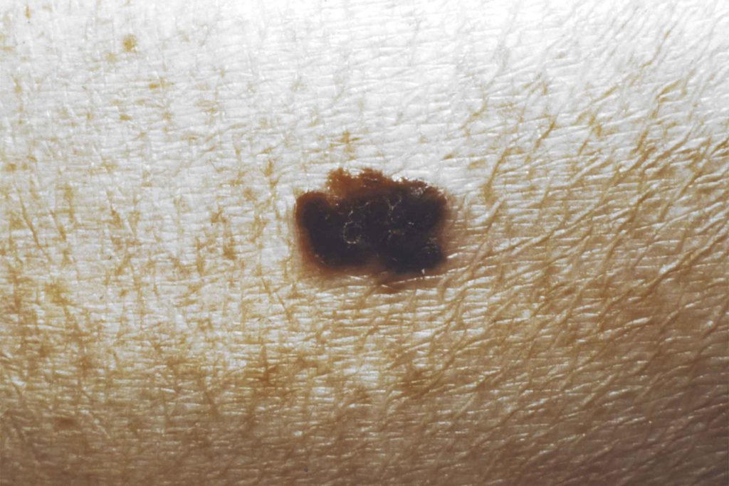 Skin Cancer Symptoms You Should Check For Now The Healthy