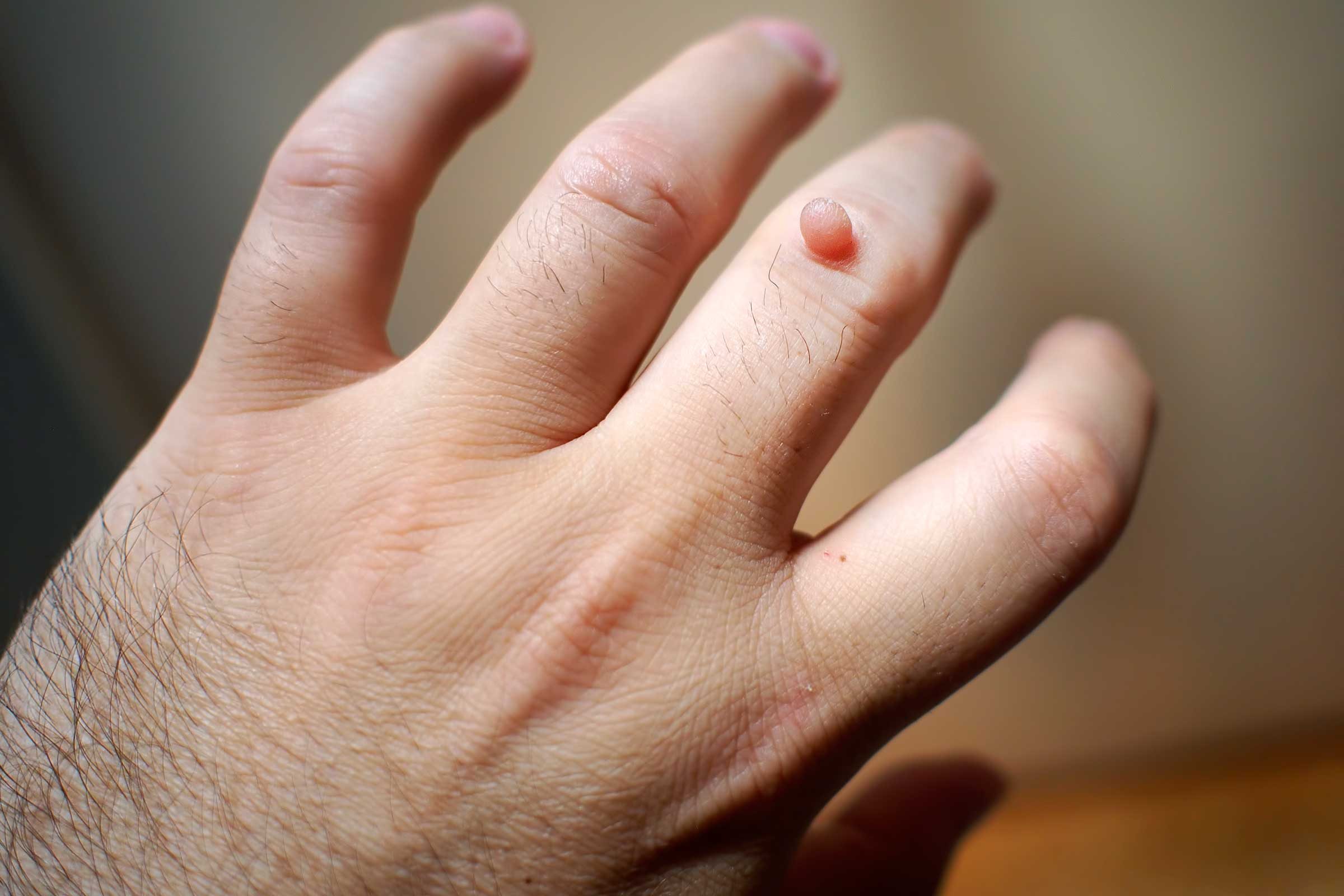 12 Home Remedies for Warts You Can Actually Make Right at Home
