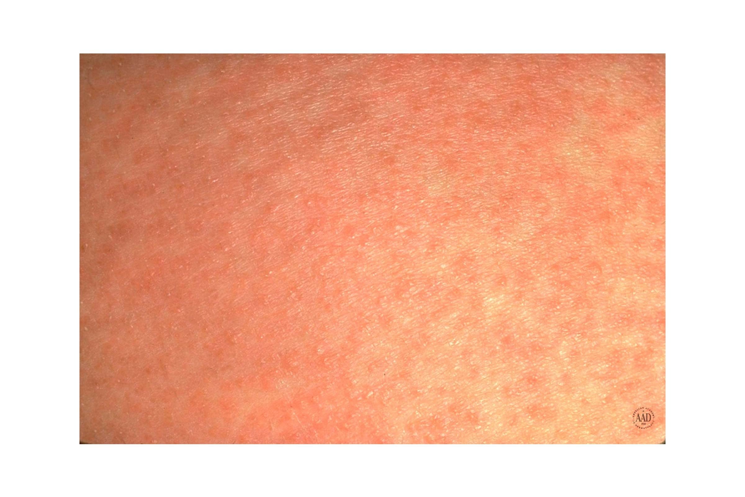 Itchy rash on inner thighs - Glow Community