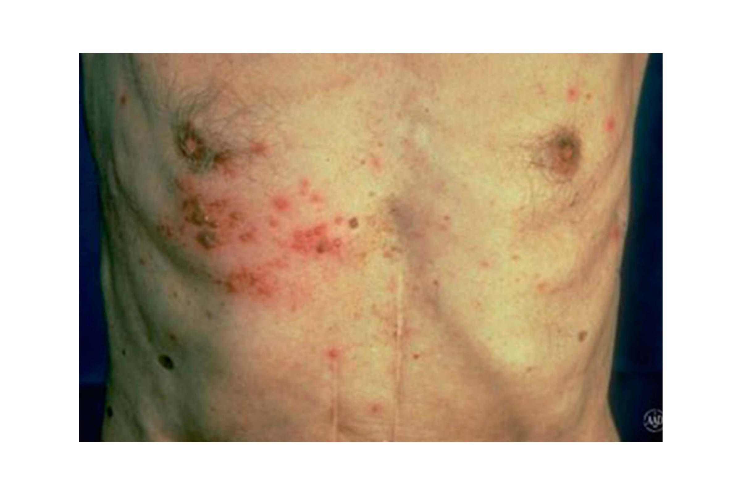 https://www.thehealthy.com/wp-content/uploads/2016/12/10-whats-that-rash-shingles.jpg?fit=700%2C467