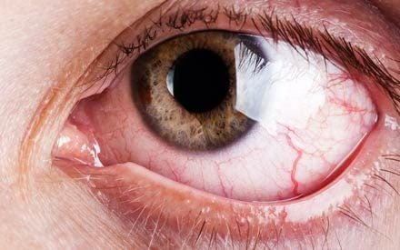 9 Reasons You Have Bloodshot Eyes—and How to Fix Them