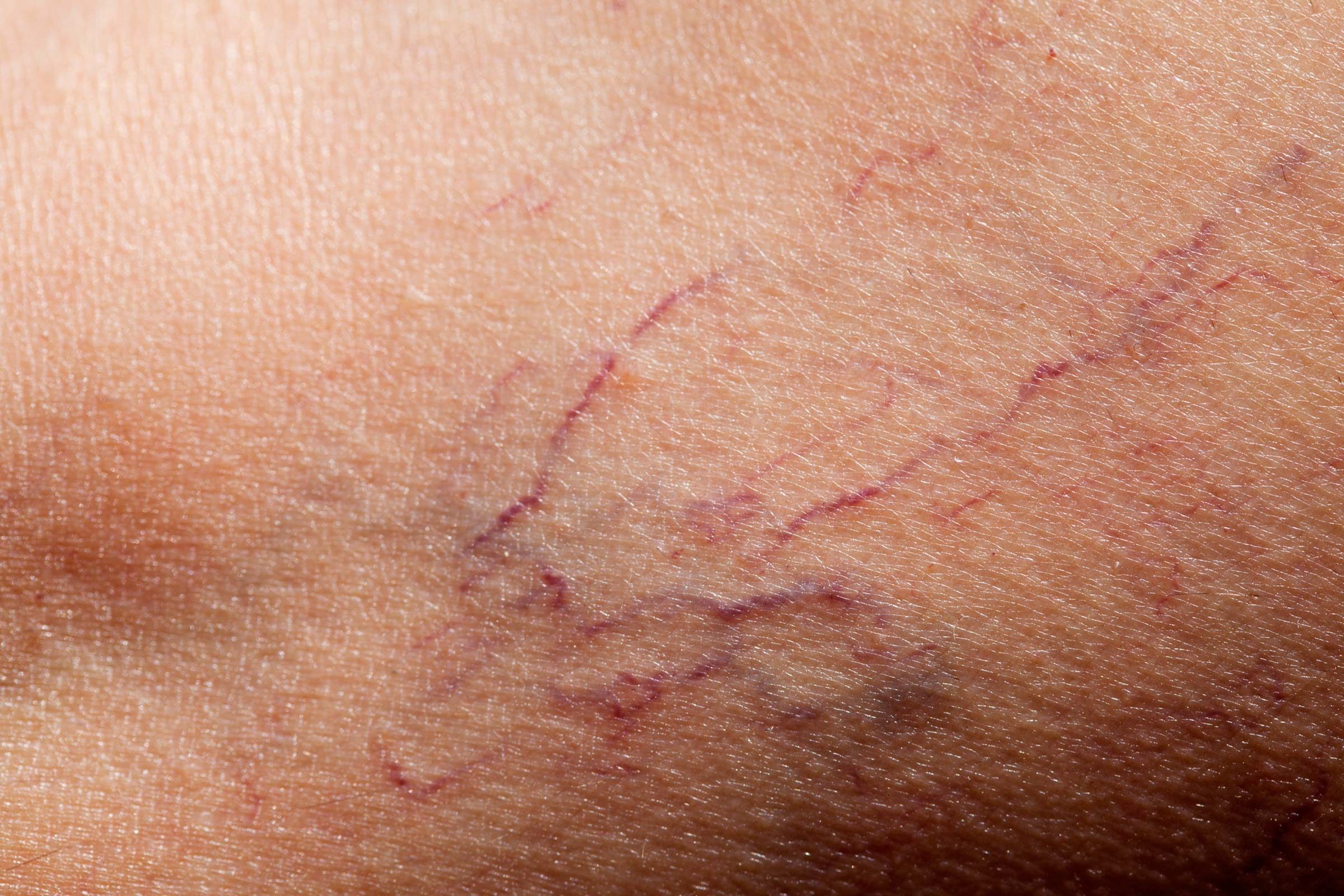 How To Erase And Prevent Broken Capillaries The Healthy