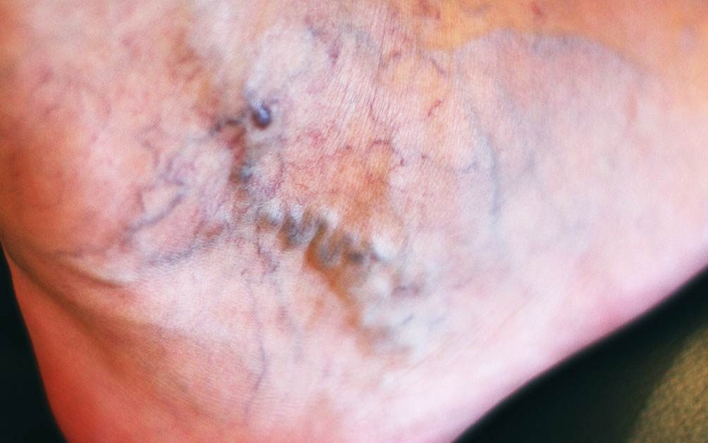 12 Things You Never Knew About Varicose Veins