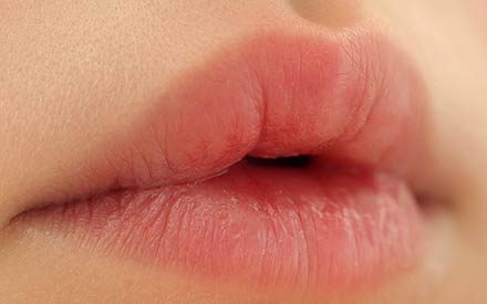 7 Reasons Your Lips Are Chapped—and How to Heal Them