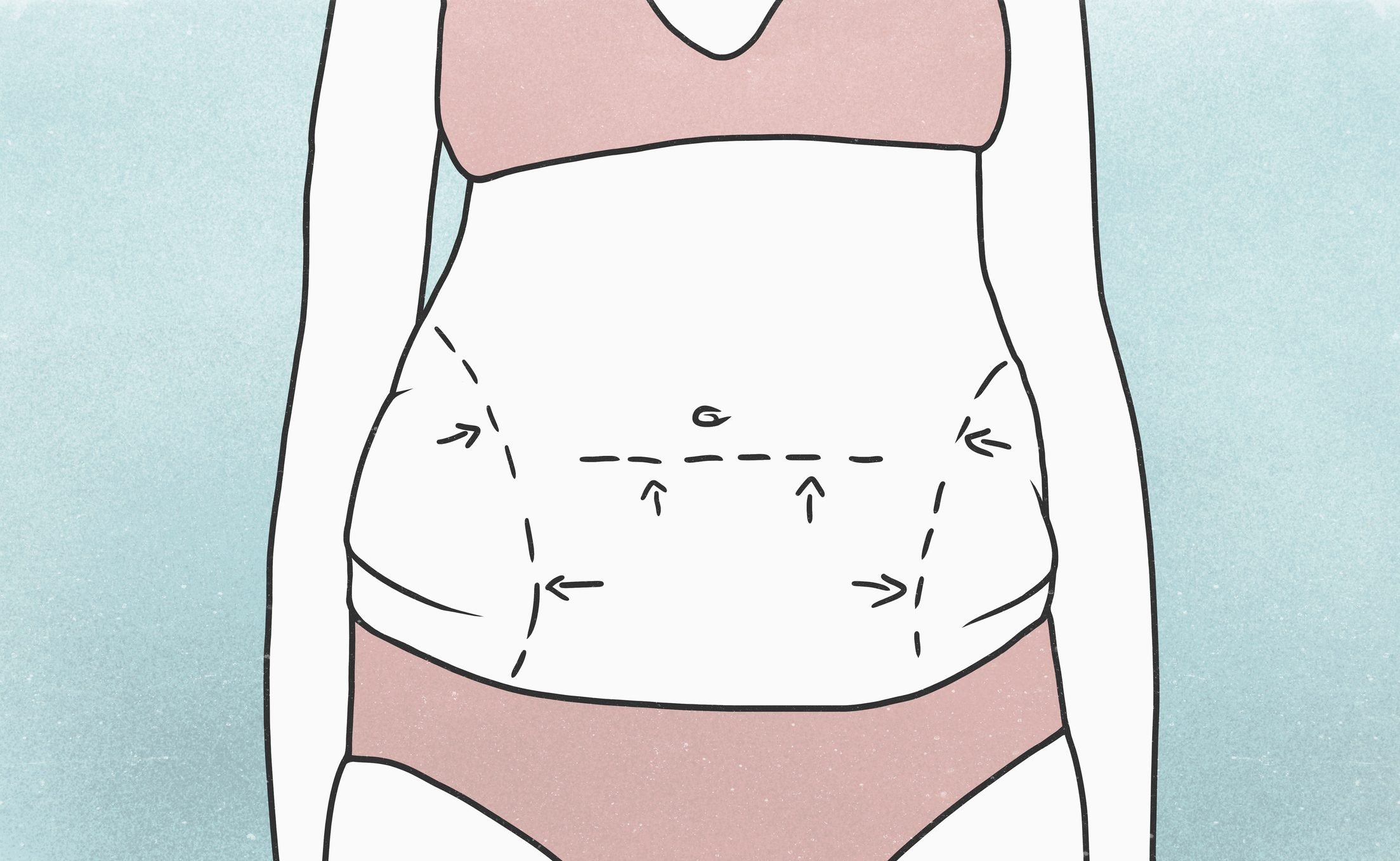 Liposuction: Everything You Need to Know