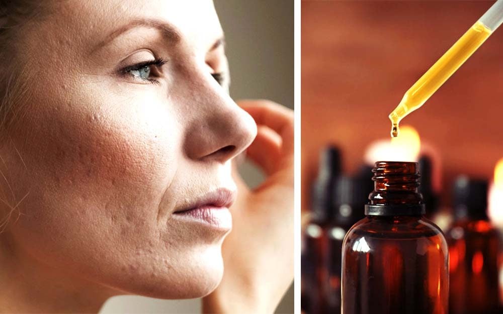 Thinking About Using Essential Oils to Fight Acne? Read This First
