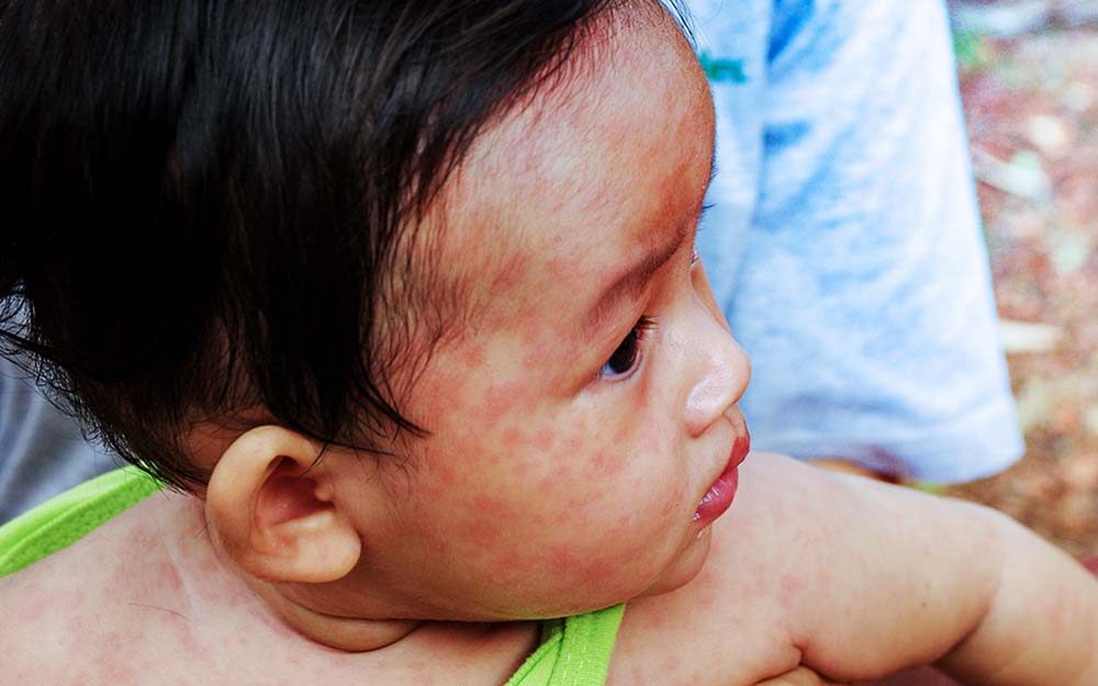 Are Measles Coming Back? What You Need to Know