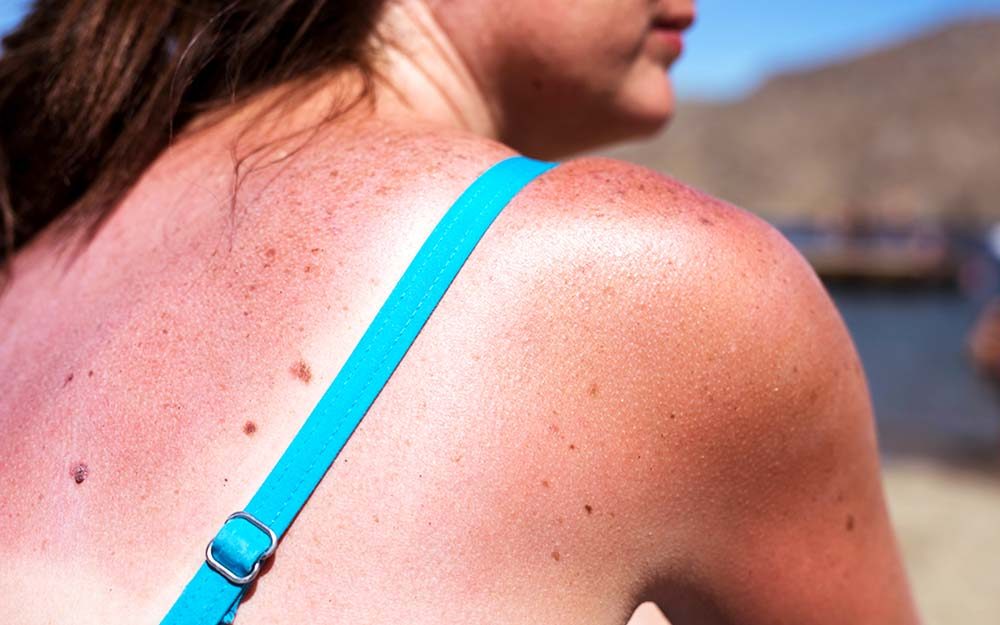 Two Types of Skin Cancer Are Skyrocketing—Are You At Risk?