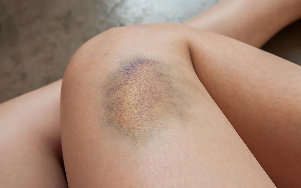 The Doctor-Approved Way to Get Rid of Bruises ASAP
