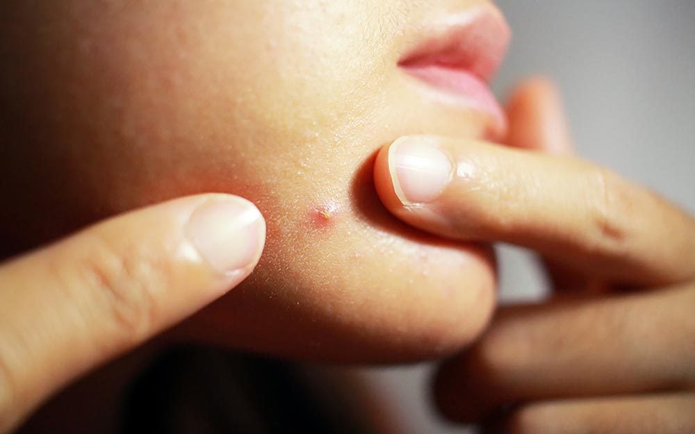 Why You Get Chin Acne—and How to Clear It Up