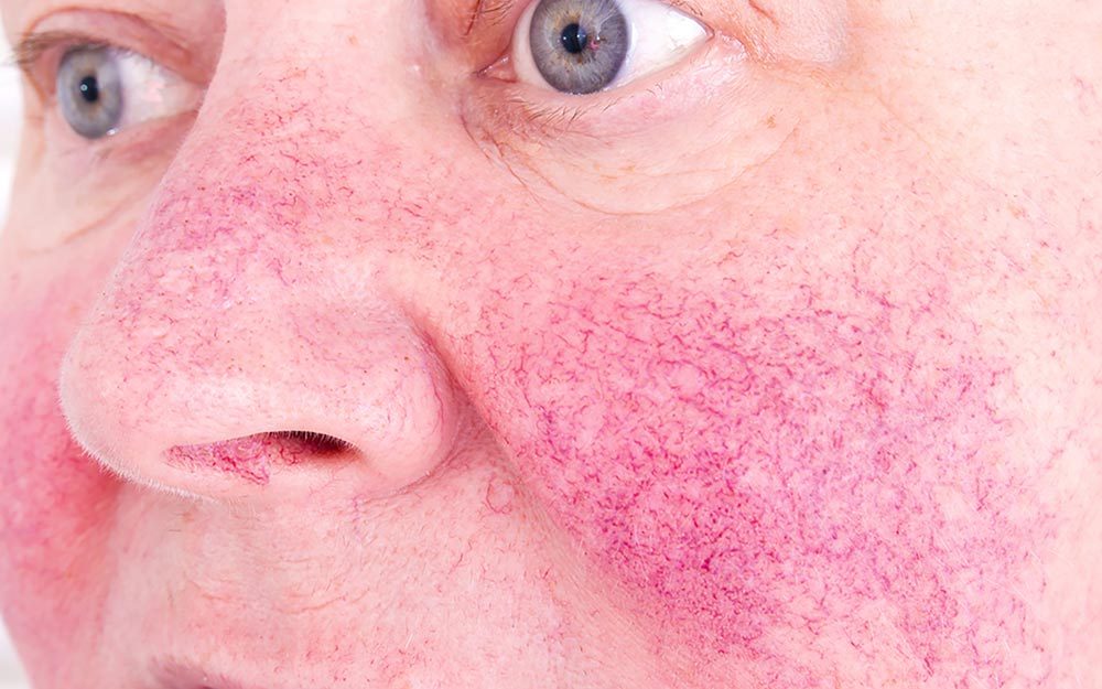 Rosacea What Is Rosacea Treatment And Causes The Healthy