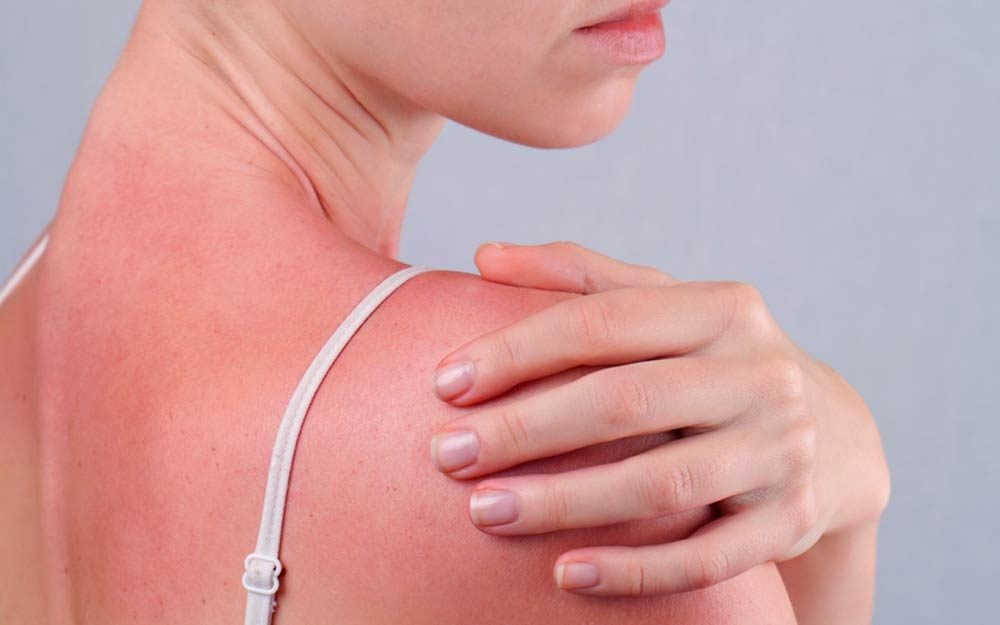 6 Silent Signs Your Sunburn Is Actually Sun Poisoning