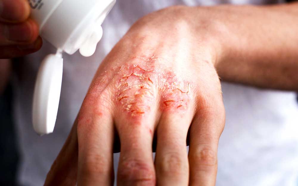 10 Effective Ways To Tame Hand Eczema – Re'equil