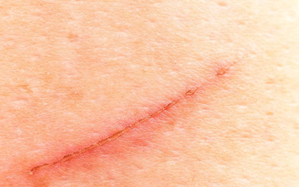 The Secret to Preventing Scars Is This One Ingredient (Hint: It's Not Neosporin!)