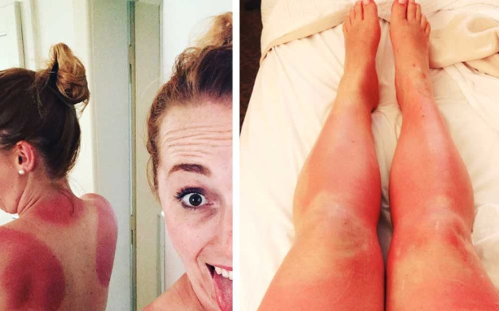 These Hilarious Sunburns Will Make You Laugh and Cringe at the Same Time