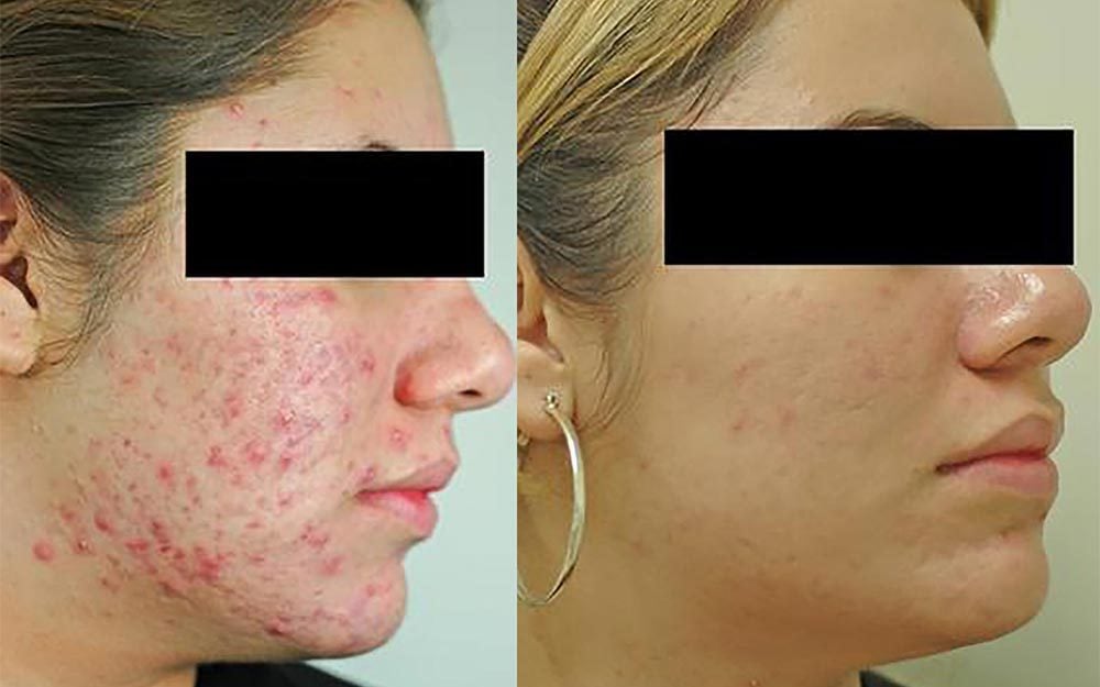dermatologist with acne patient