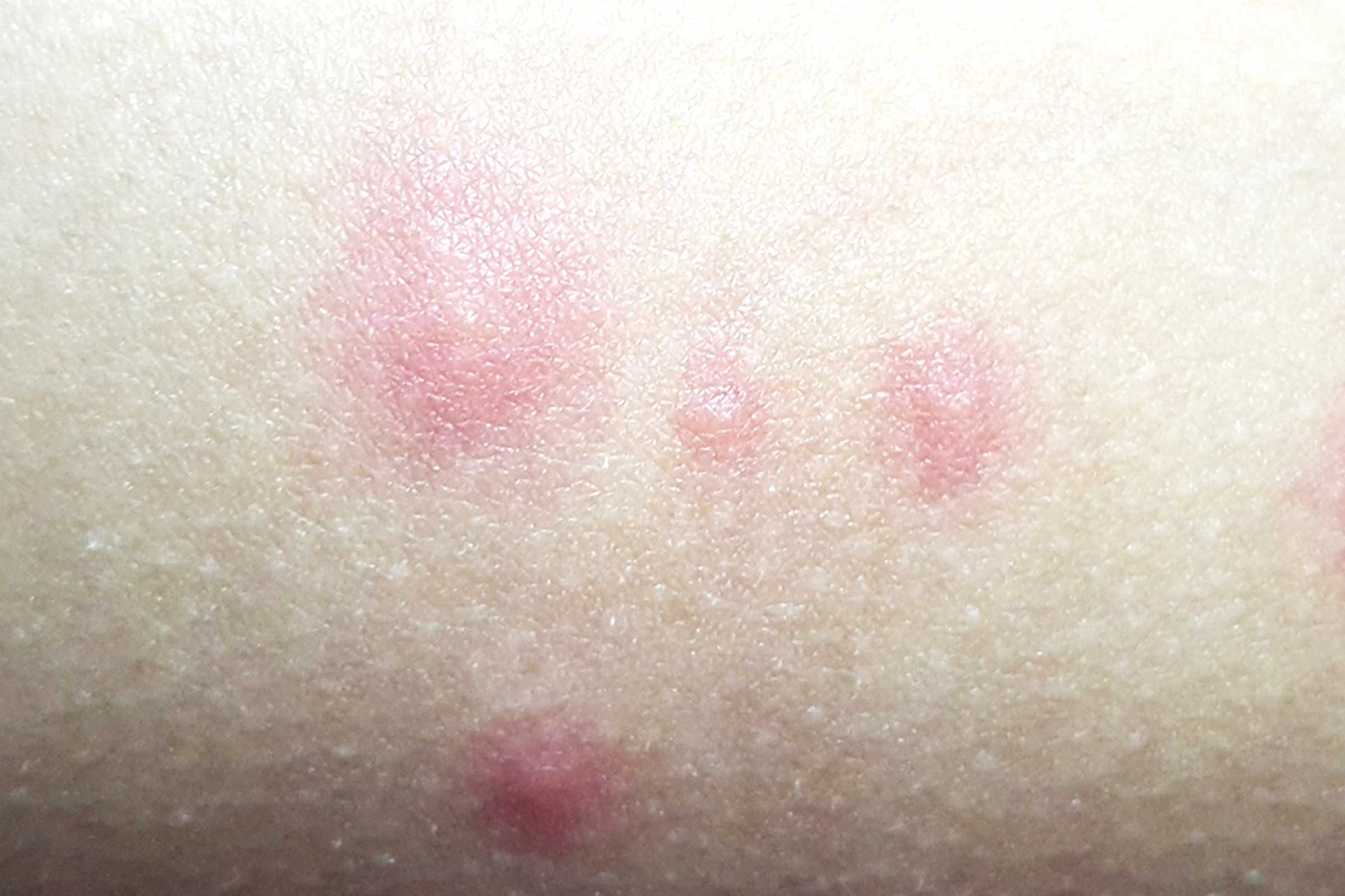 Identifying Bug Bites Here S What Bit You The Healthy