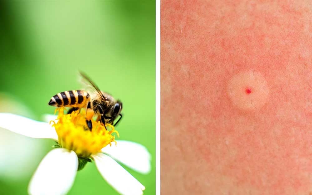 Identifying Bug Bites: How to Figure Out What Bit You