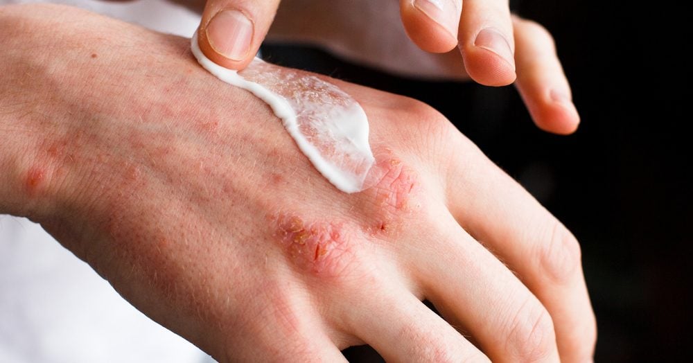 7 Eczema Treatments Dermatologists Use on Themselves