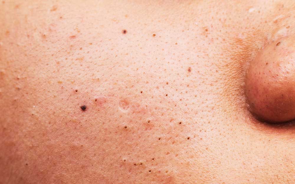 There's a New Way to Remove Blackheads—and Beauty Pros Can't Stop Talking About It