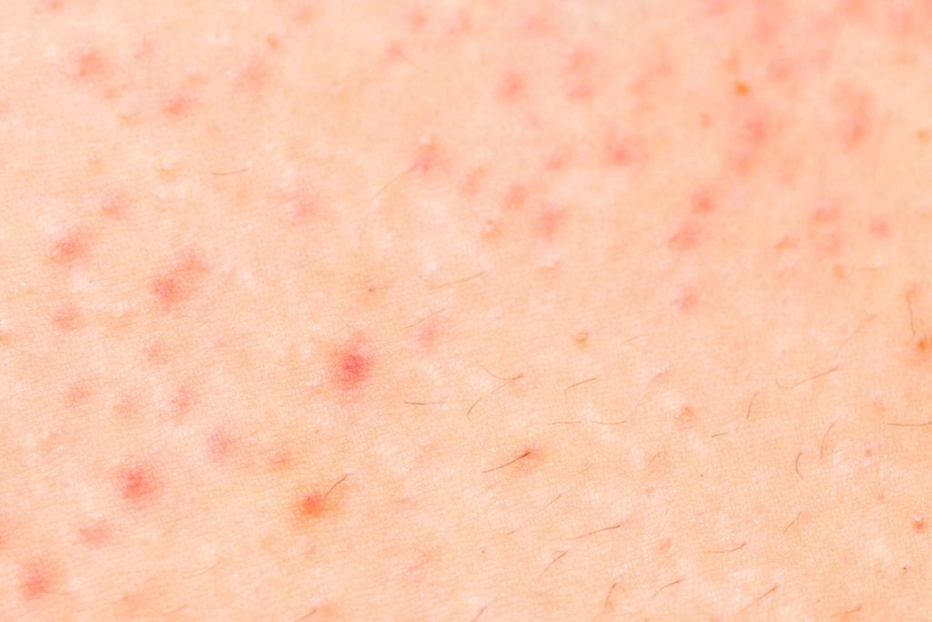 Small Red Spots On Skin Not Itchy Flat Jameslemingthon Blog