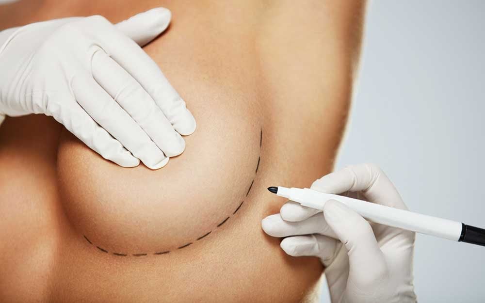 Things I Wish I'd Known Before Getting Breast Reduction Surgery.