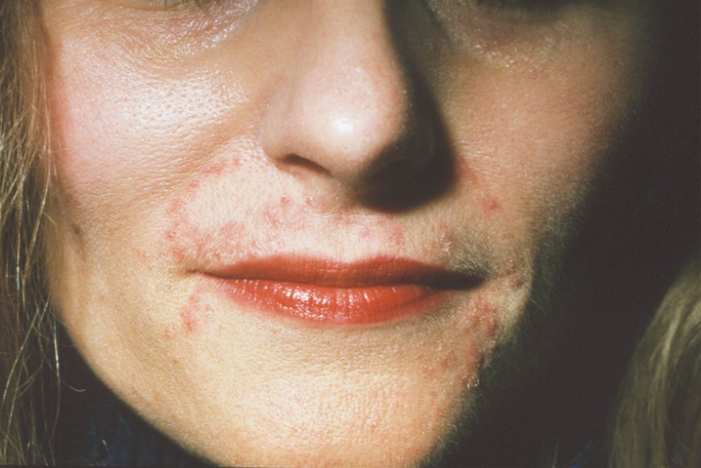 Skin Conditions That Look Like Acne But Aren T The Healthy