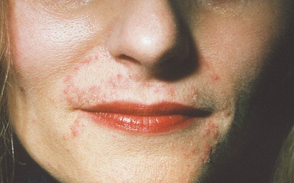 7 Skin Conditions That Look Like Acne But Aren't