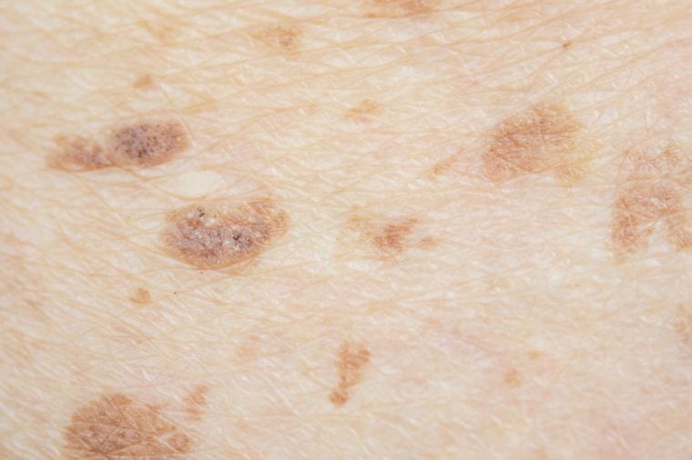 Does Breast Cancer Cause Skin Rash ️updated