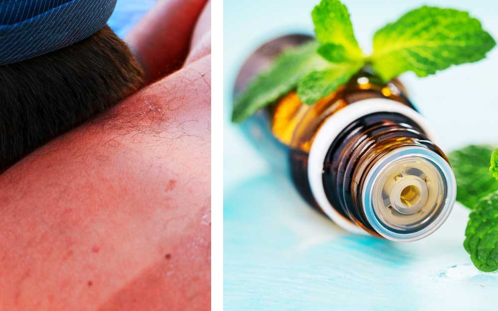 This Is How You Can Use Essential Oils to Treat a Sunburn