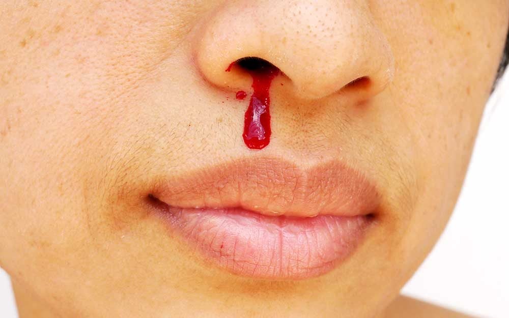 6 Surprising Reasons You Might Be Getting Nosebleeds