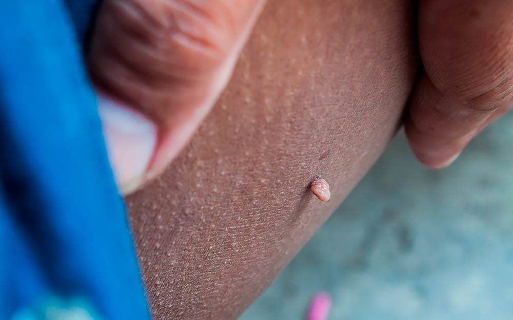 How to Get Rid of Skin Tags, According to a Dermatologist