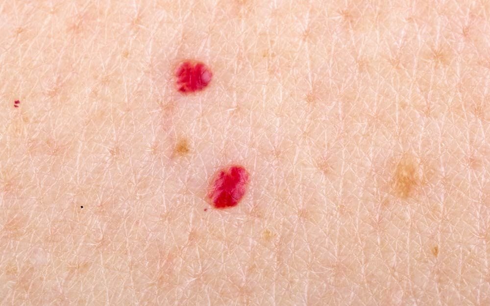 How to Remove Cherry Angiomas (Red "Moles") The Healthy
