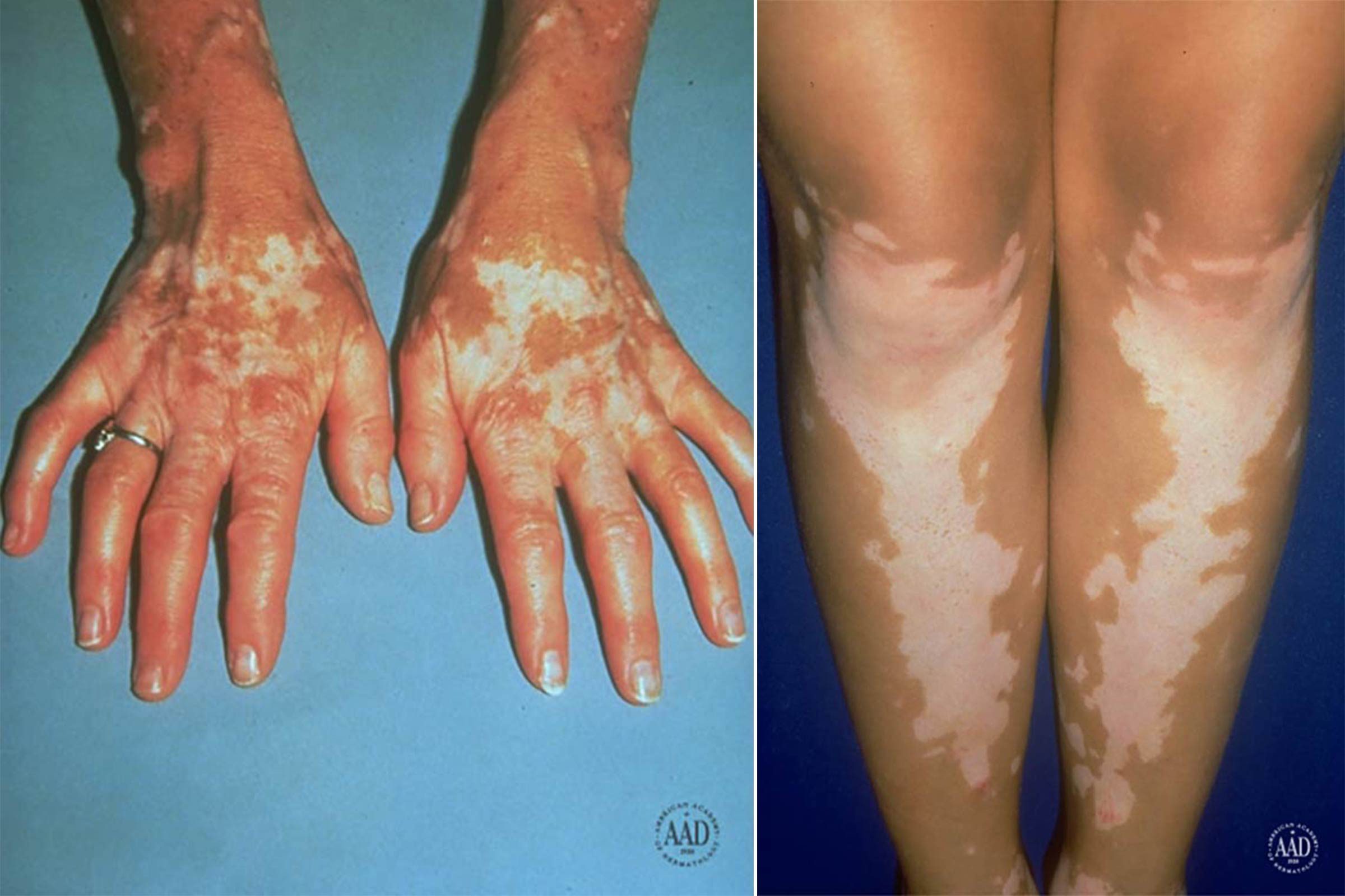 This Is How To Treat White Spots On Skin The Healthy 7421