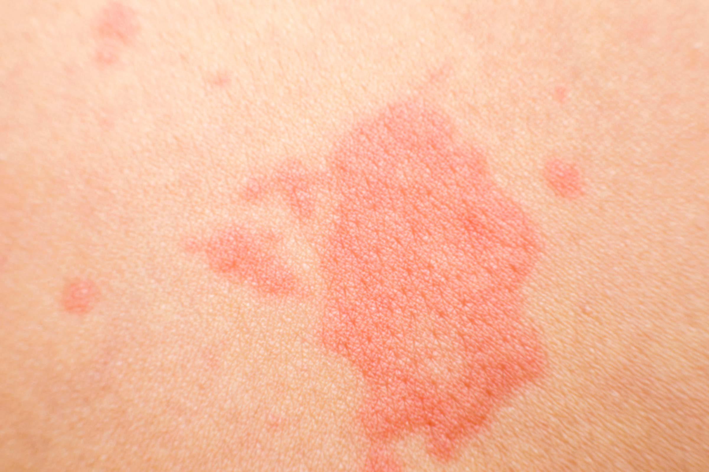  Red Spots On Skin Pictures Causes Treatment Online Dermatology Images 