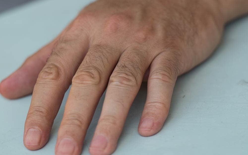 This Specific Fingernail Mark Could Be a Melanoma Symptom
