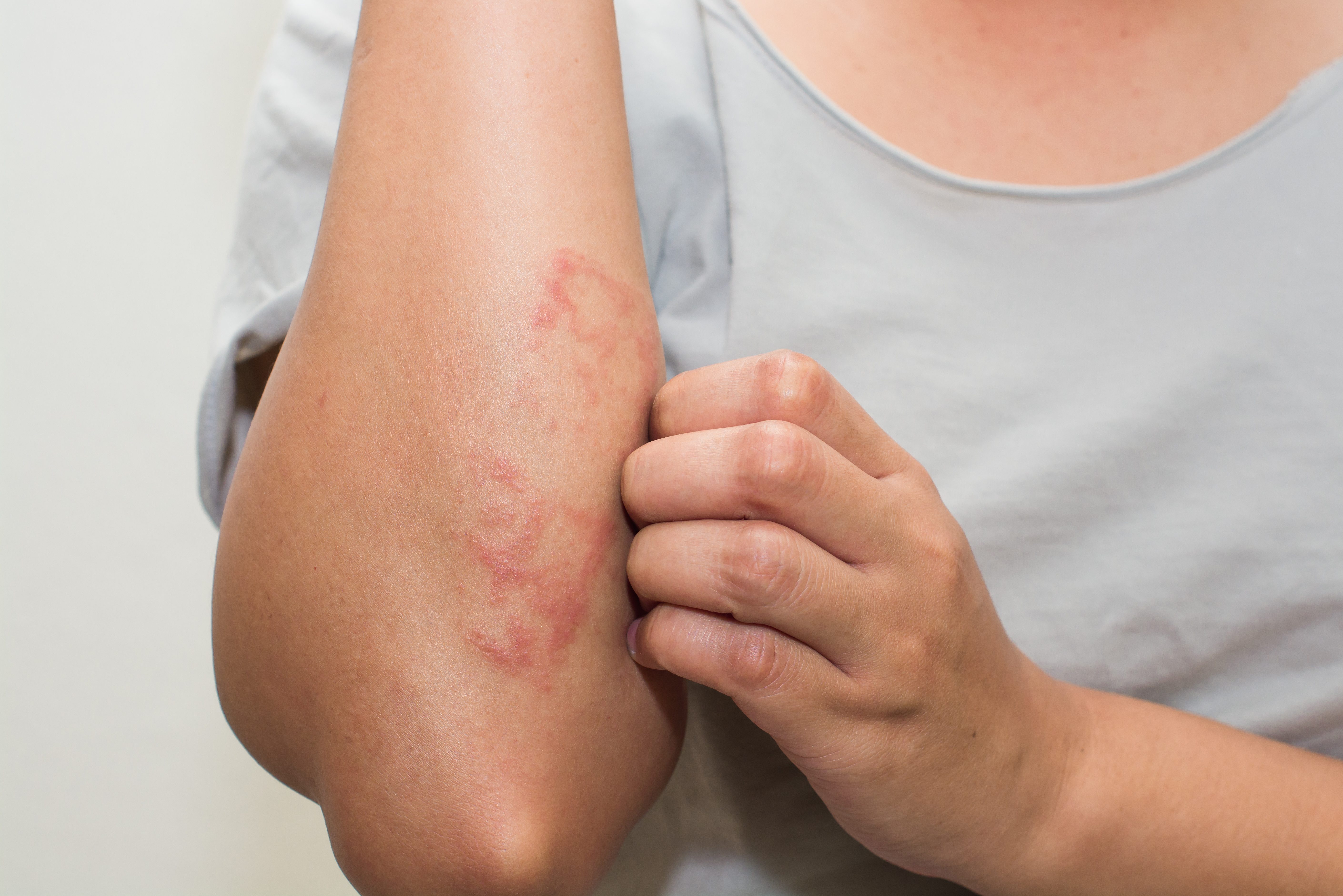 Is It Eczema or Something Else? 5 Clear Signs to Never Ignore