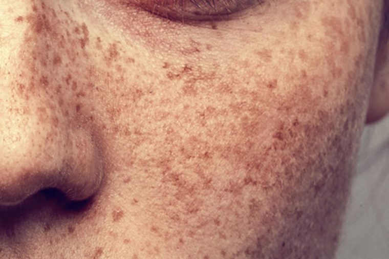 The Difference Between Melasma And Other Skin Spots The Healthy 