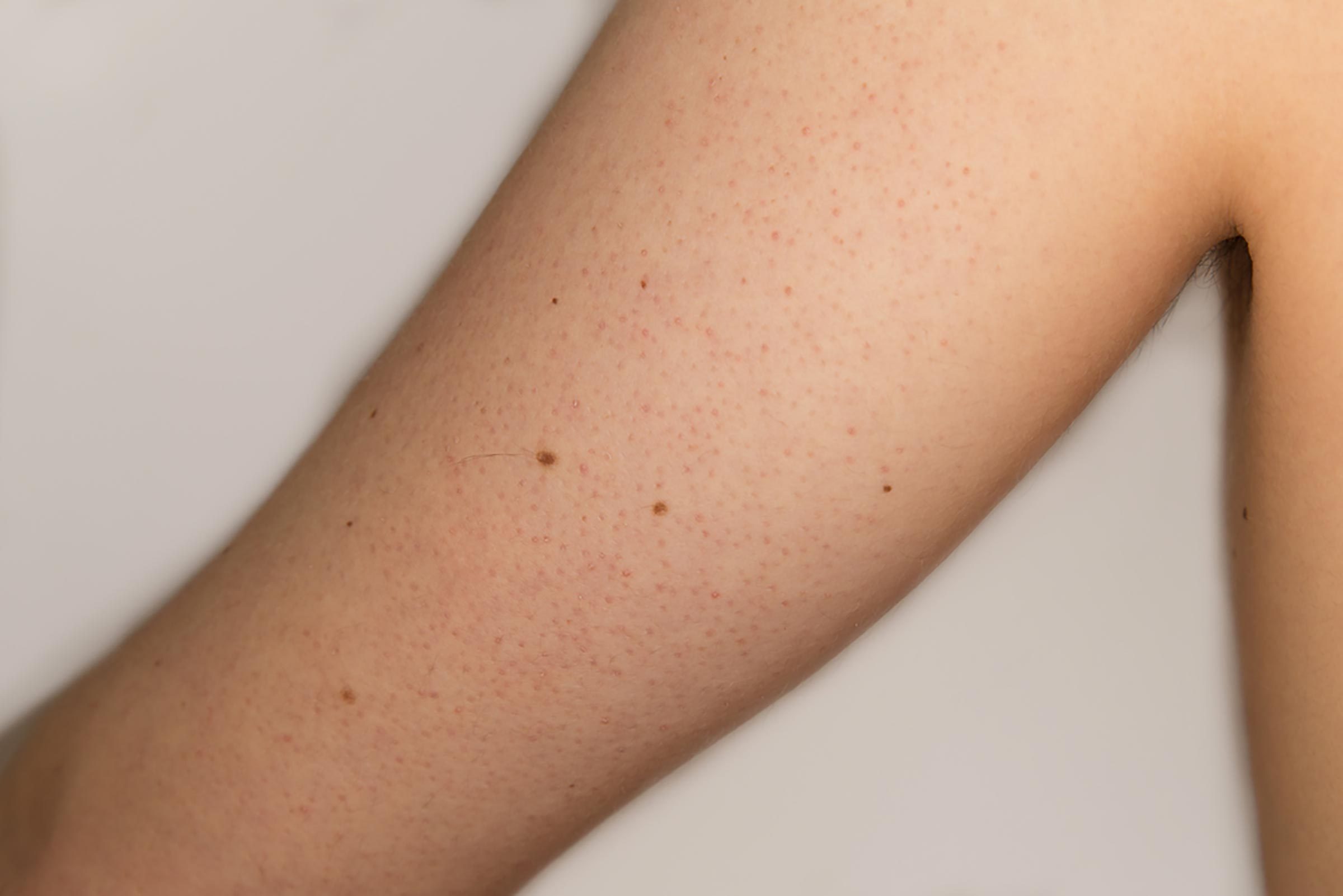 Boils, Cysts, Ingrown Hairs, and 11 Other Skin Mysteries Explained