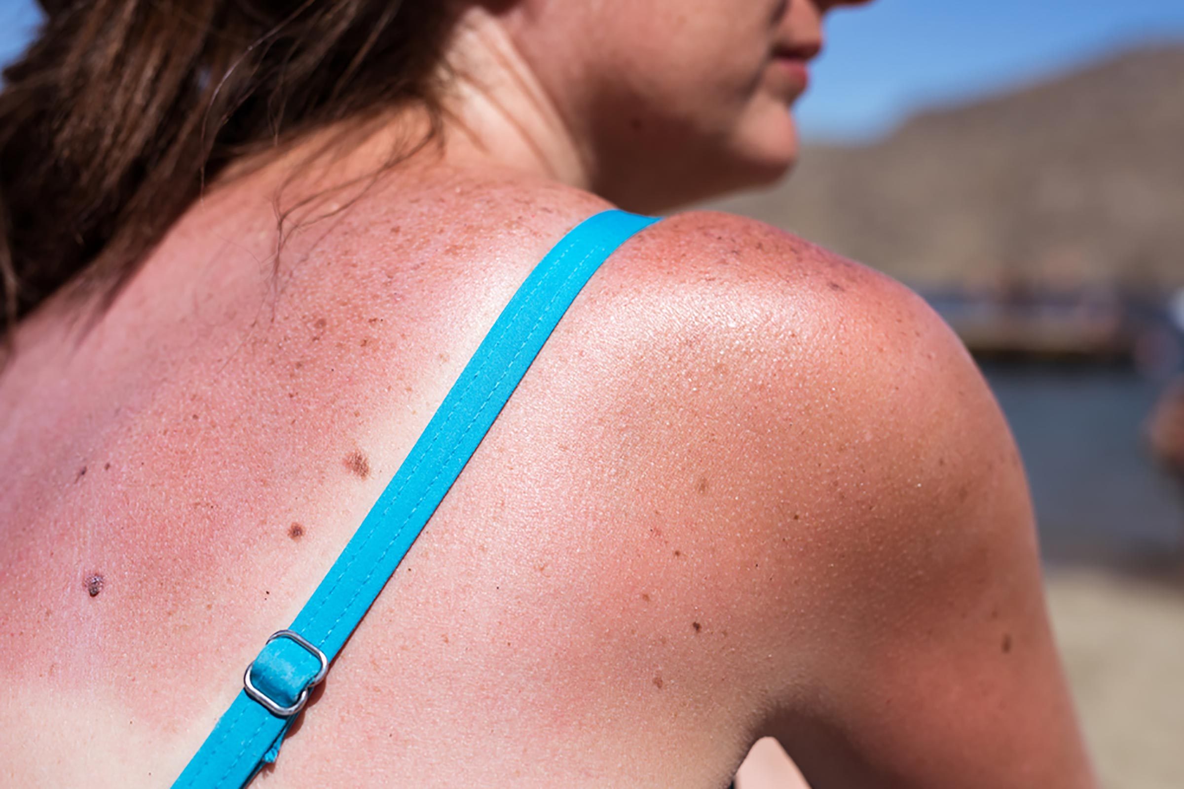 9 Clear Signs You’ve Gotten Too Much Sun