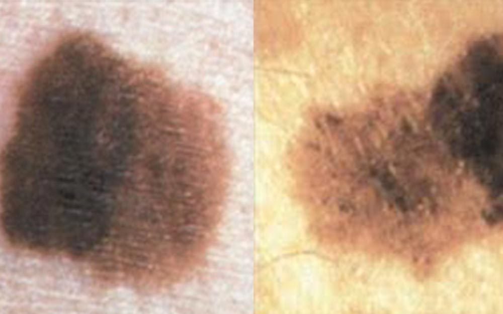Whats The Difference Between Melasma Sun Spots And Other Skin Spots Courtesy American Academy Of Dermatology FT 