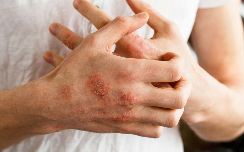 10 Types of Poison Ivy Treatment You’ll Be Thankful to Know