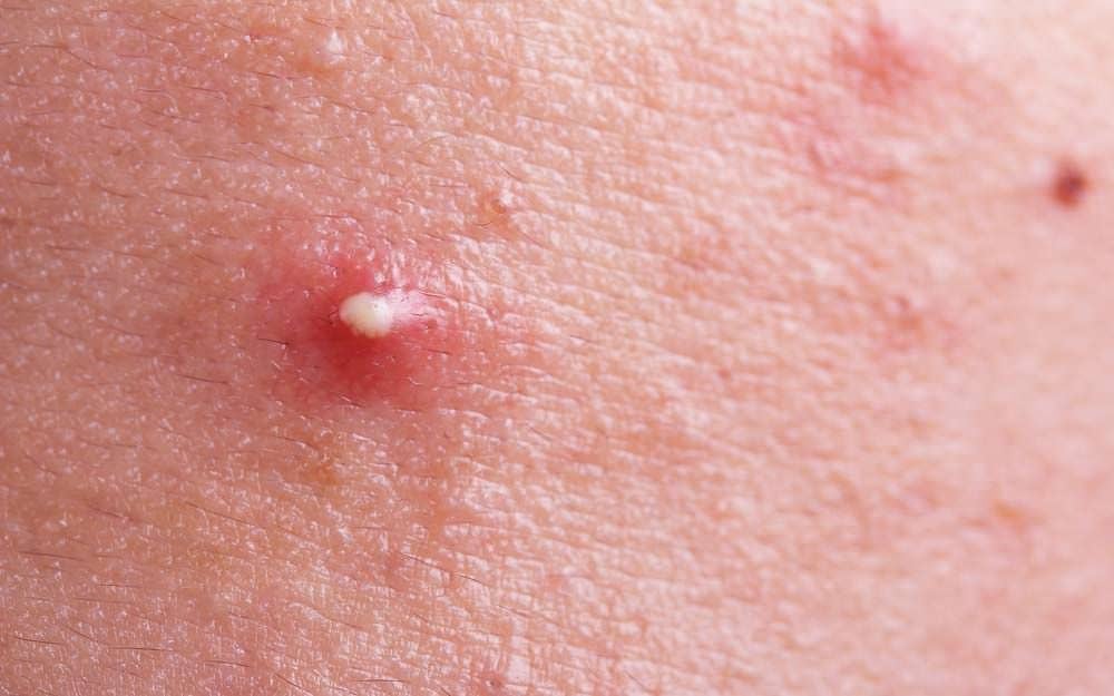 Why You Should Never, Ever Pop a Pimple in The "Danger Triangle"
