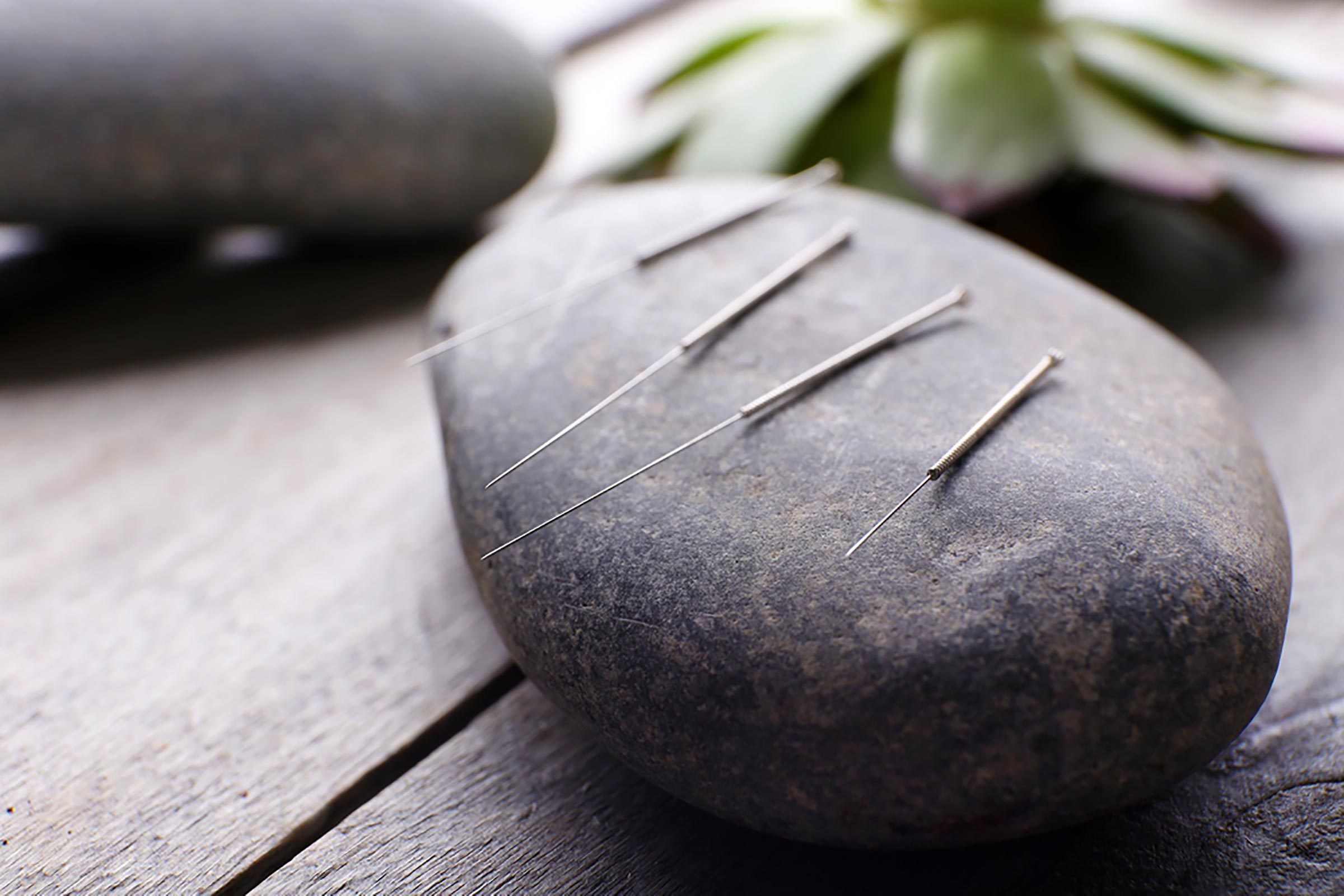 7 Compelling Reasons You Should Try Acupuncture for Weight Loss