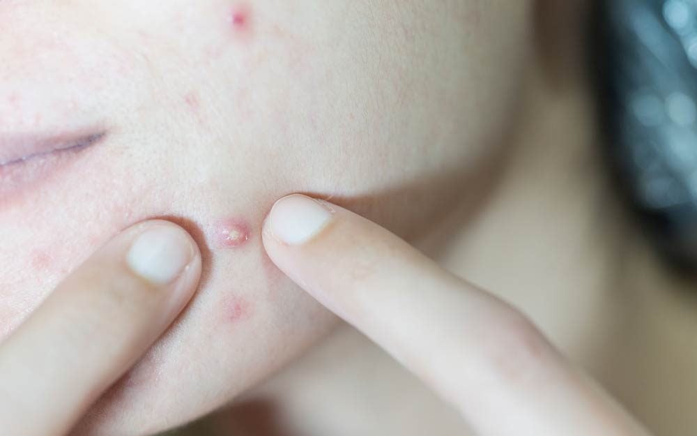 This Is the Easiest Way to Get Rid of a Pimple, According to a Dermatologist